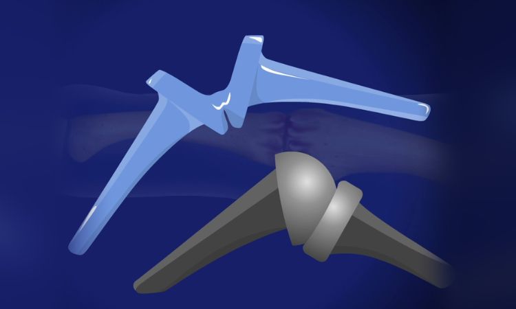 Pros And Cons Of Finger Joint Replacement